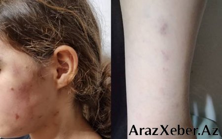 Lənkəranda döyülən 15 yaşlı qız sığınacağa YERLƏŞDİRİLƏCƏK