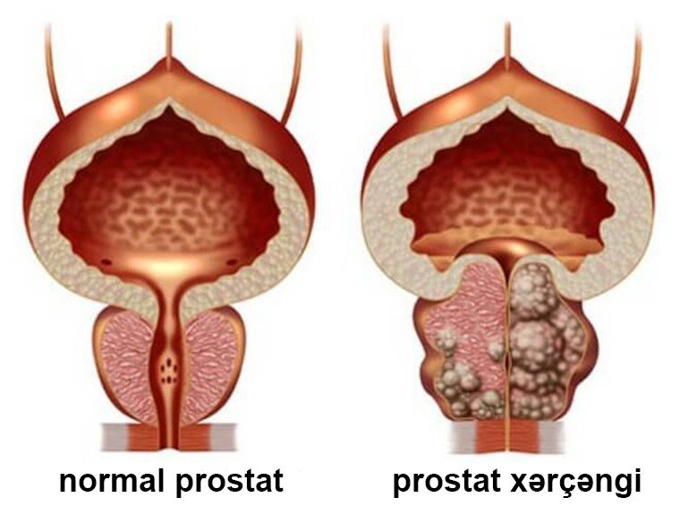 TEZ-TEZ SİDİK İFRAZINDAN PROSTAT XƏRÇƏNGİNƏ QƏDƏR - BİR ADDIM! TƏHLÜKƏNİ NECƏ VAXTINDA MÜƏYYƏN ETMƏLİ? TÜRKİYƏ BAŞ UROLOQU İLƏ MÜSAHİBƏ.